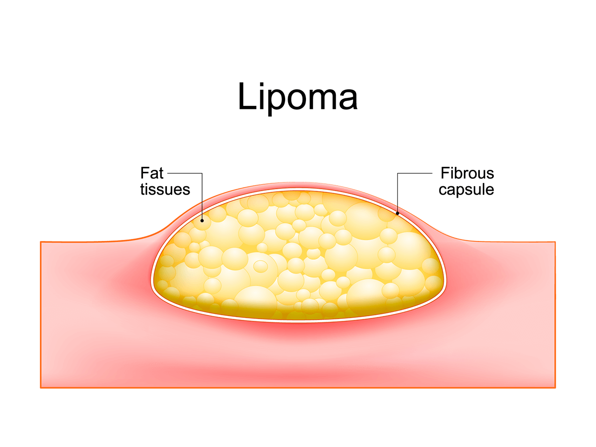 Diagram of lipoma and cyst